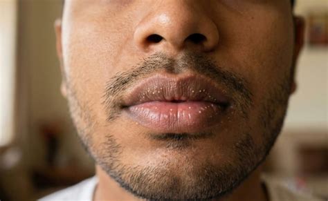 Noticed tiny white spots on your lips? Here's what they are and whether ...