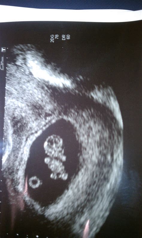 Baby Girl Ultrasound Pictures At 9 Weeks at Kimberly Helms blog