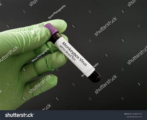 Monkeypox Virus Mpv Blood Test Tube库存照片2189527173 | Shutterstock