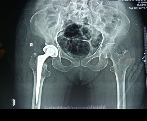 Hip Fractures Surgery in Ahmedabad | Dr. Rachit Sheth