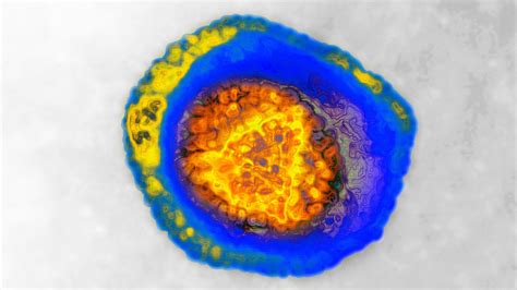 Herpes Is Slowly Retreating, but the Infection Remains Common - The New York Times