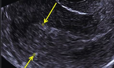 POCUS Promising for Diagnosing Retained Products of Conception, but ...