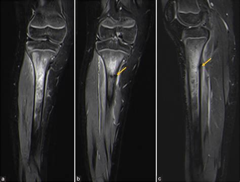 Tibial Stress Fracture Mri