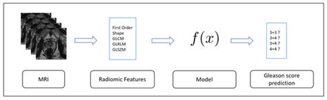 Radiomics for Gleason Score Detection through Deep Learning