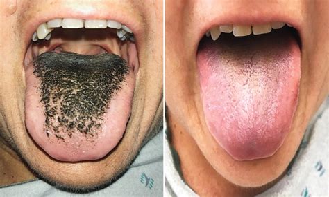 antibiotic-reaction-left-woman-with-black-hairy-tongue | জিভে চুল ...