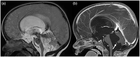 Mega Cisterna Magna Vs Arachnoid Cyst