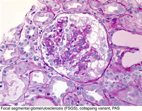 Pathology Outlines - FSGS-collapsing variant