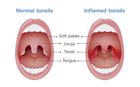Swollen tonsils: is it tonsillitis?