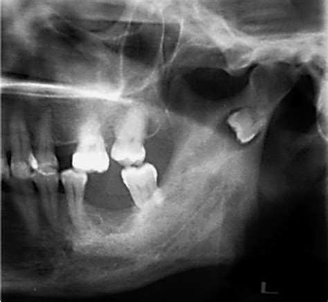 Academy of Dental Knowledge: Introduction to Third Molar Surgery: Part ...
