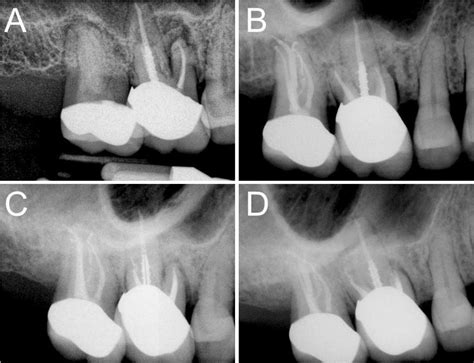 Pain In Rct Treated Tooth at Frank Hamlin blog