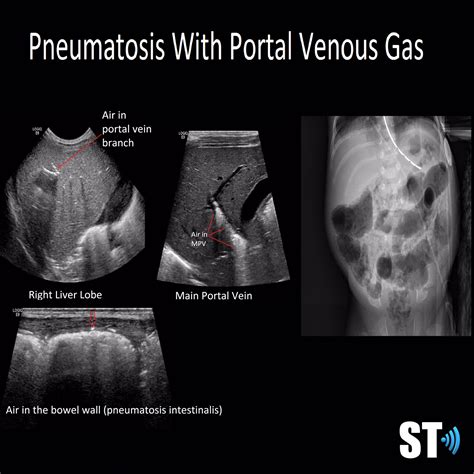 Portal Venous Gas