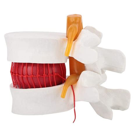 Buy sunwes 1:1.5 Human Lumbar Disc Herniation Demonstration Model of ...