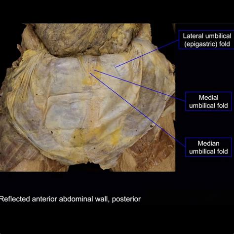 Medial Umbilical Ligament Cadaver