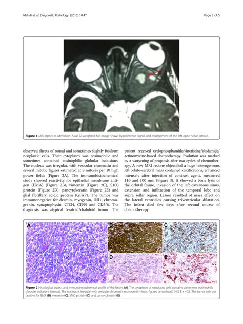SOLUTION: Primary atypical teratoid rhabdoid tumor of the optic nerve a rare entity in an ...