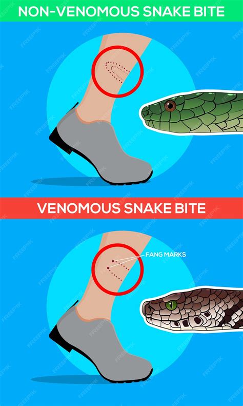 Bite Of Venomous And Non Venomous Snake
