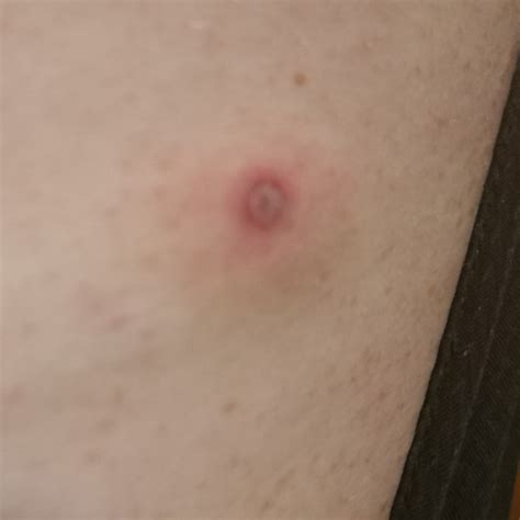 my wife pulled a tick off me 8 hours ago. Does the "bullseye" show up ...
