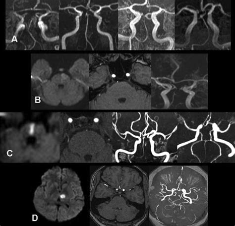 Basilar Artery Stroke