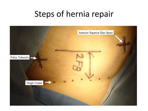 Surgical anatomy of inguinal hernia | PPTX