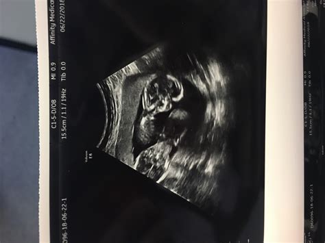 15 Weeks Pregnant with Twins: Tips, Advice & How to Prep | Twiniversity ...