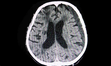 Blocking artery feeding dura during surgical drainage may reduce risk ...