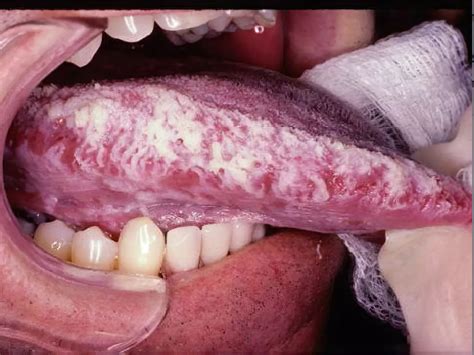 White Spots on Tongue: 7 Pictures to Compare Symptoms