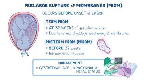 Video: Prelabor rupture of membranes: Clinical sciences
