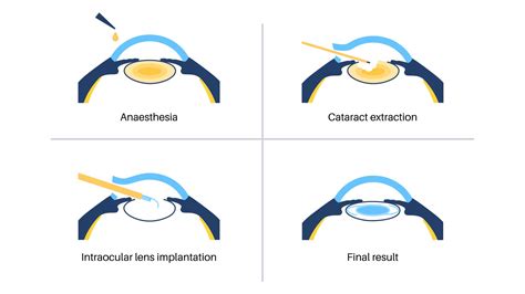 How Long Does Cataract Surgery Take?