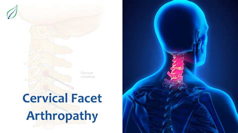 Understanding Cervical Facet Arthropathy: Causes, Symptoms, and ...
