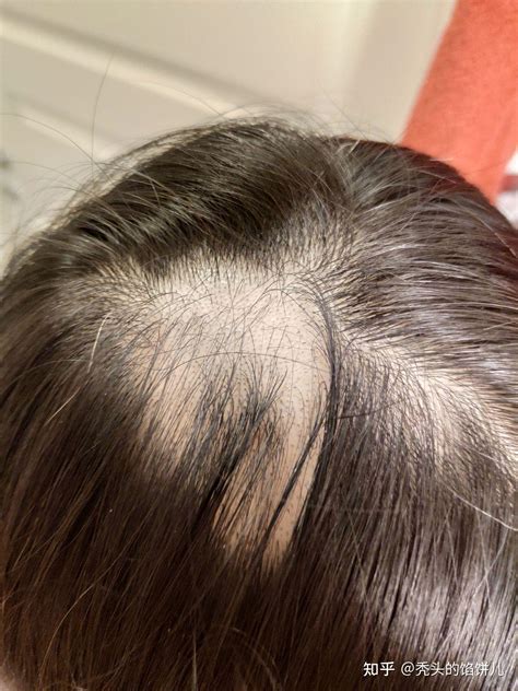 斑秃必看，斑秃治疗后长出来白头发，头皮长毛毛原因 - 每日头条