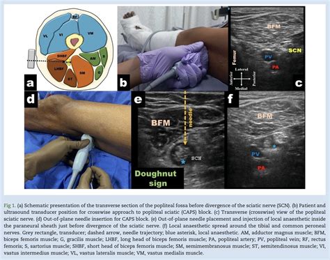 Sciatic Nerve Block Anterior Approach