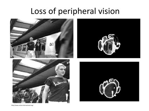 PPT - Clinical Presentation of Vitreoretinal Disorders PowerPoint Presentation - ID:249503