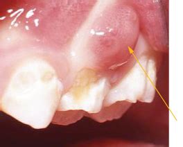 Bildergebnis für abscess tooth popped in mouth