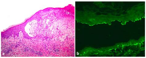 Blisters and Milia around the Peritoneal Dialysis Catheter: A Case of ...