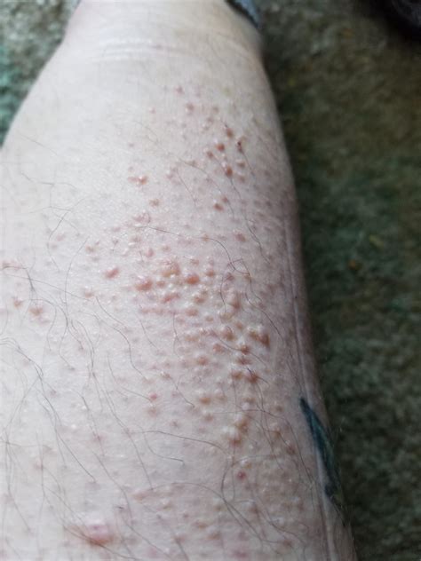 Bumps on lower legs for over a year : r/DermatologyQuestions
