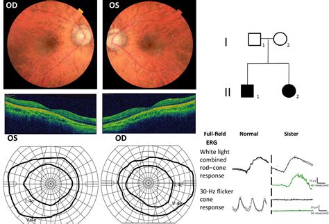 Genotype and Phenotype in an unusual form of Laurence–Moon–Bardet–Biedl syndrome - Kamme - 2017 ...