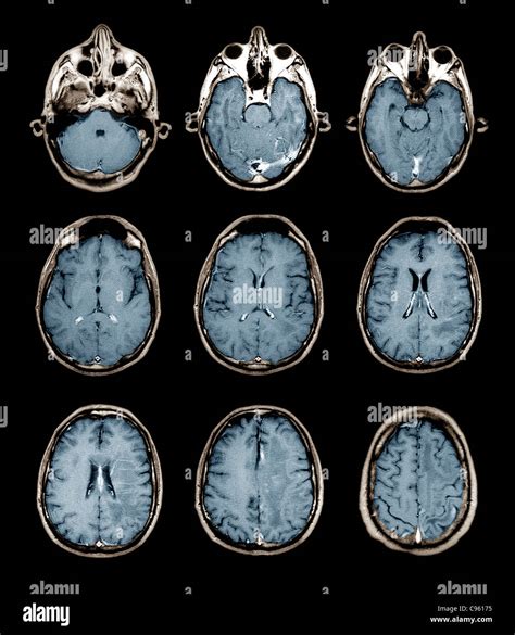 Normal brain, MRI scans Stock Photo - Alamy