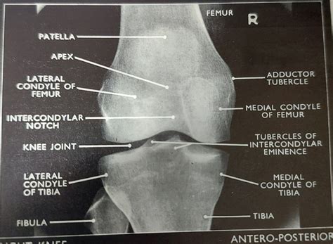 Adductor Tubercle X Ray