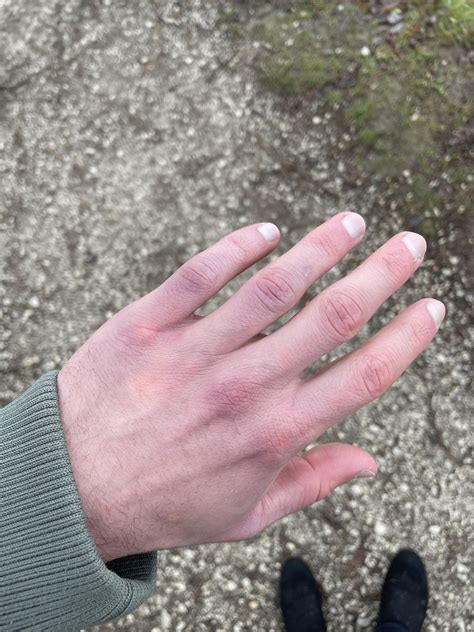 Is this Raynauds? My hands are always red and/or purple and there are ...