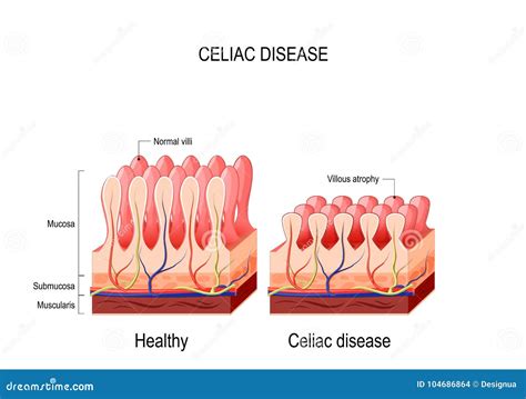 Mustard Flour Coeliac Disease at Victor Vanhoy blog