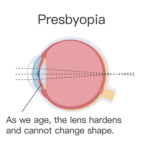 Presbyopia - 清晰眼科 | Clarity Eye Centre