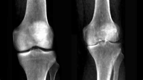 AI Tech Accurately Diagnoses Knee Arthritis from Medical Images | Dell Medical School
