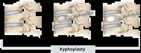 Optimizing Anesthetic Techniques for Percutaneous Kyphoplasty: A ...