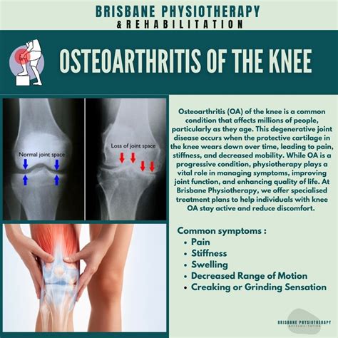 Osteoarthritis Knee Swelling Osteoarthritis Diagnosis & Treatment
