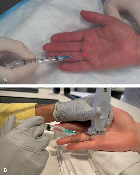 Injections of the Hand and Wrist: Part I. Trigger Finger, First Carpometacarpal Joint ...