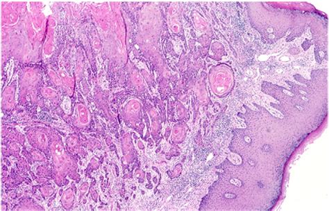 Vulvar Melanoma Pathology - melanoma of the vulva