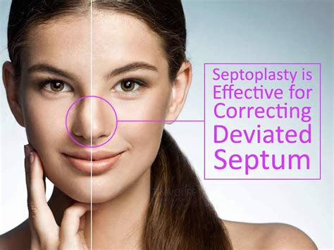Deviated Septum Surgery
