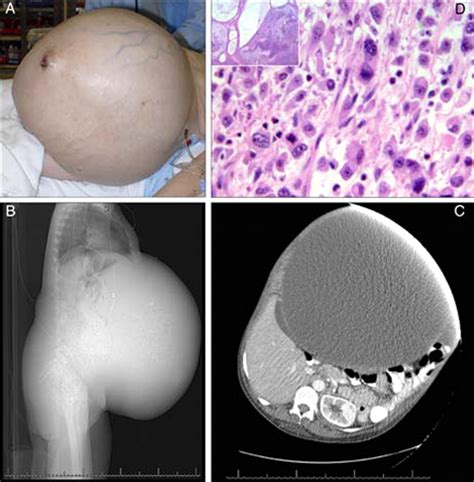 Sister Mary Joseph’s nodule | BMJ Case Reports