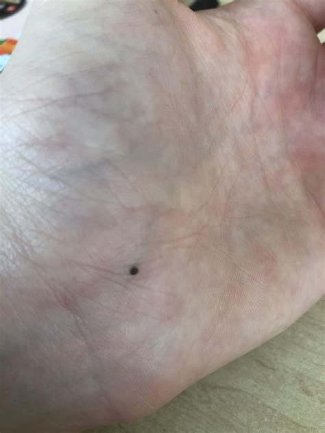 What is this black dot? It been 2 weeks on my hand never had it : r/medical