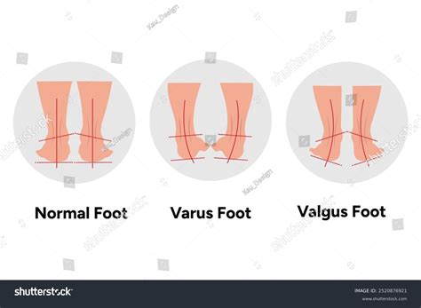 Normal Varus Valgus Foot Footprint Orthopedist Stock Vector (Royalty ...