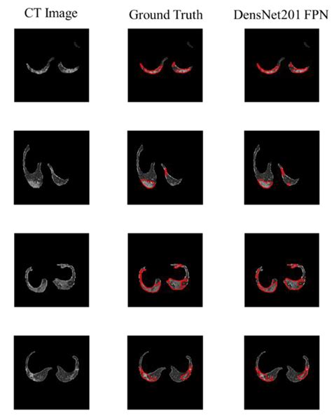 Detection and Severity Classification of COVID-19 in CT Images Using ...